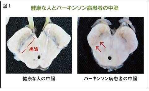 全日本コーヒー協会「Coffee Break」2014August vol.80より※通常の中脳の黒質にはメラニン色素を含むドーパミン神経が密集している。一方、パーキンソン病患者の脳では中脳のメラニン含有ドーパミン神経が変性脱落するため、黒質の黒い部分が少なく見える(矢印の部分)