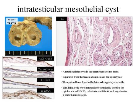 intratesticular cyst by Dr. S. Kuwamoto