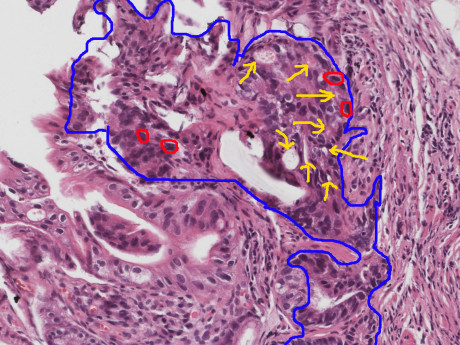 stomach cancer kaisetu