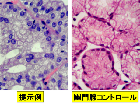 pyloric gland adenoma