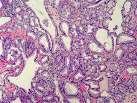 pyloric gland adenoma2