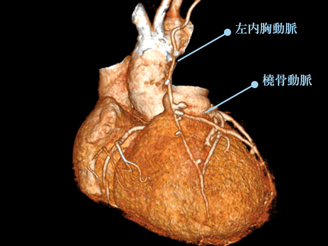 冠動脈バイパス手術