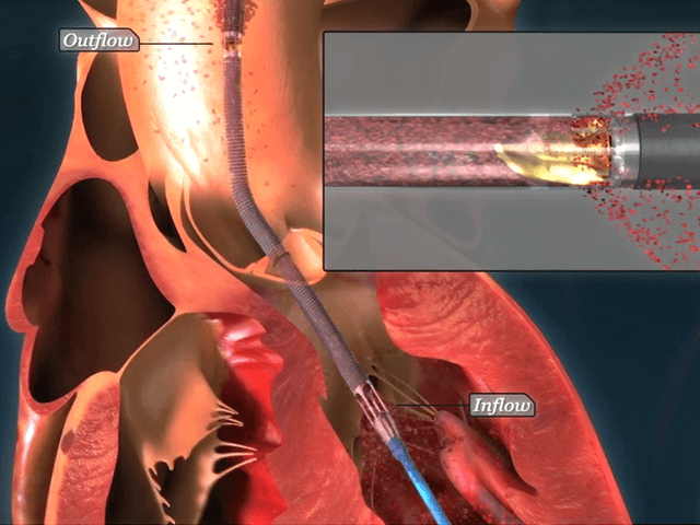 インペラ (IMPELLA)