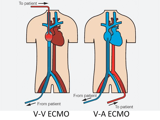 エクモ(ECMO)