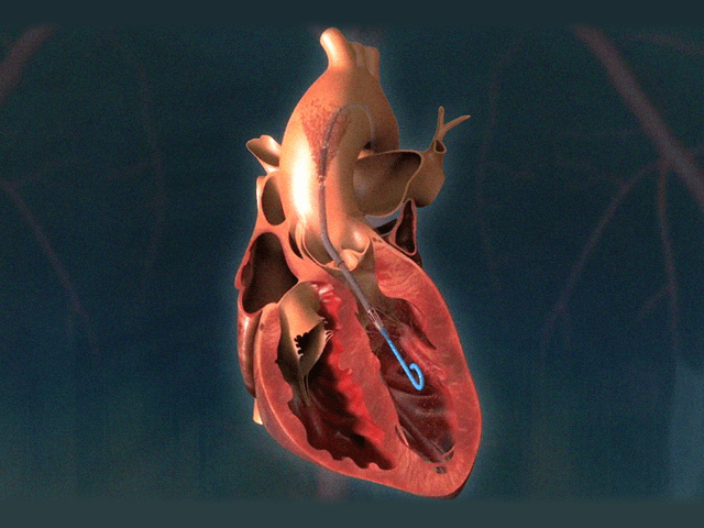 mechanical-heart