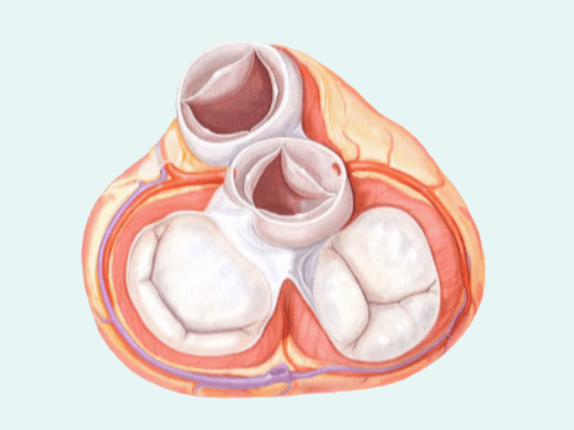 心臓弁膜症
