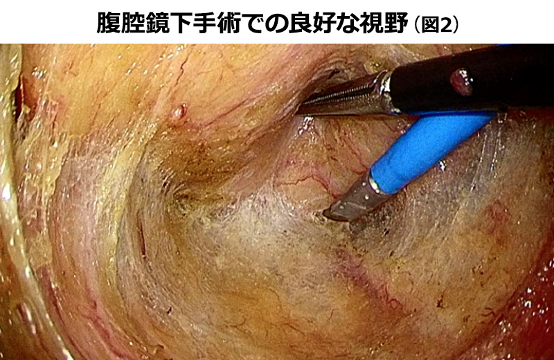 腹腔鏡下手術での良好な視野