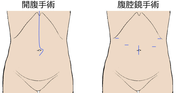 開腹手術と腹腔鏡手術の創