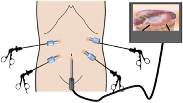 腹腔鏡手術のイメージ