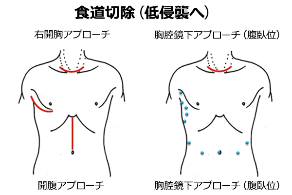 食道切除