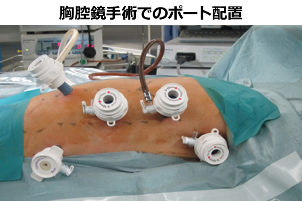 胸腔鏡手術でのポート配置