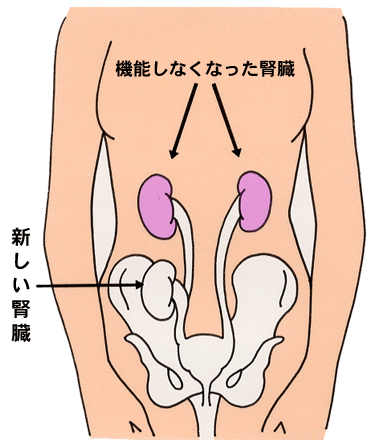 腎移植1