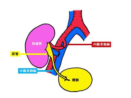 腎移植5-2