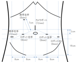 トロカーと言われる筒を計6本下腹部に挿入(図1)。