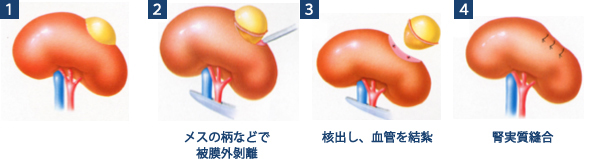 手術の流れ 黄色：腎腫瘍 (図2)。
