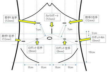 トロカー留置位置(図1)