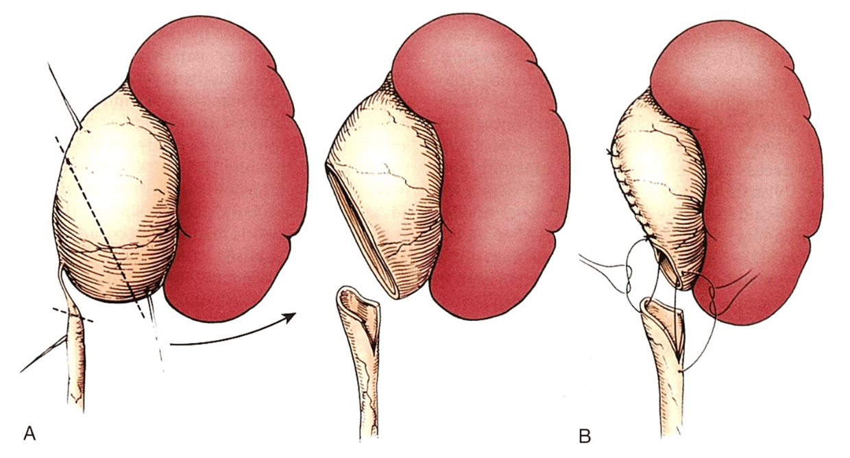 手術の流れ(Campbell-Walsh Urologyより引用)