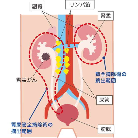 腎尿管全摘除術と腎全摘除術の摘出範囲 (泌尿器ケア2012.(17)8より引用)