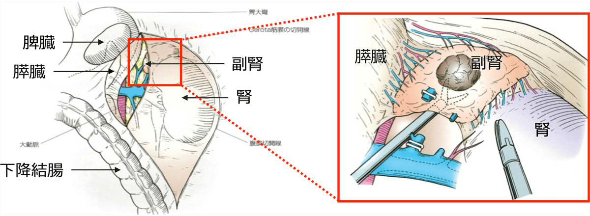 手術の流れ(新Urologic Surgeryシリーズ4 メジカルビュー社より引用改変)