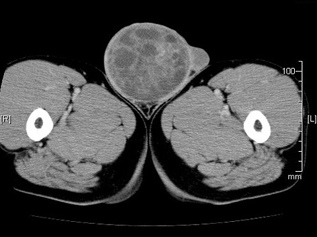 精巣がんの原因は何ですか?