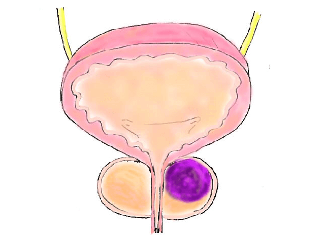 thumbnail_悪性疾患-)-前立腺癌