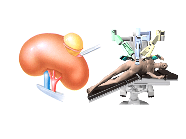 thumbnail_先進的医療-)-ロボット支援腎部分切除術