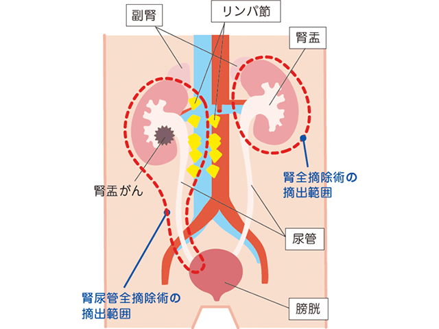 thumbnail_先進的医療-)-ロボット支援腎尿管全摘除術