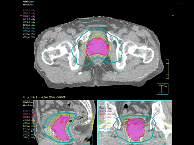thumbnail_先進的医療-)-前立腺癌-)-ハイドロゲルスペーサーを併用した前立腺癌患者に対する強度変調放射線治療IMRT治療（±ホルモン治療）