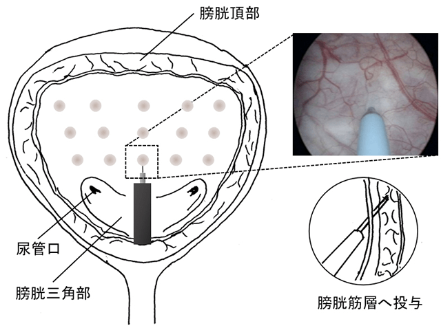 thumbnail_先進的医療-)-排尿障害-)-ボツリヌス療法