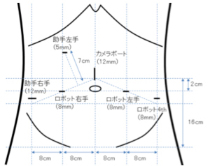 トロカーと言われる筒を計6本下腹部に挿入